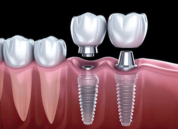 implants