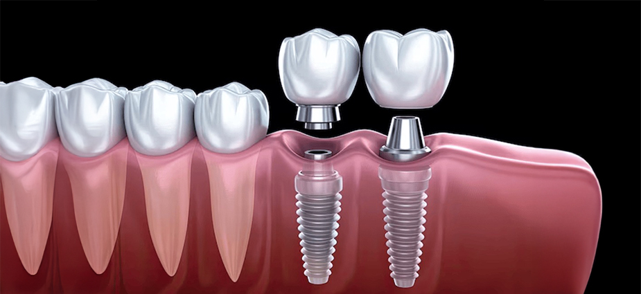 implants